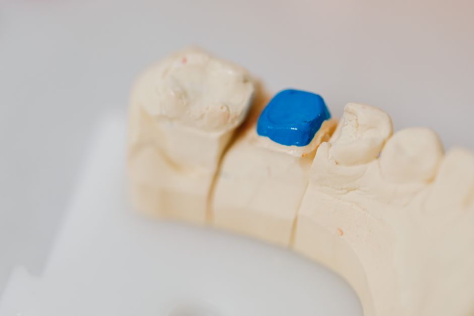 Diş Kaplama Hakkında Sık Sorulan Sorular ve Cevapları